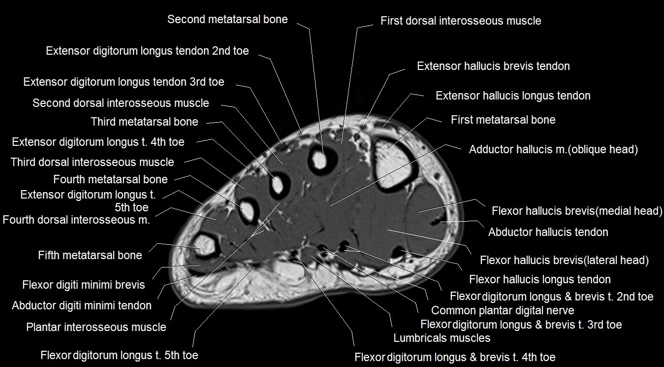 MRI 3T foot axial cross sectional anatomy image 19.webp